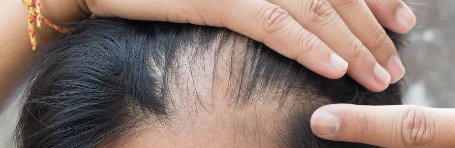 Hair Loss